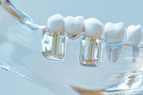 Entdecken Sie die Vorteile von Zahnimplantaten