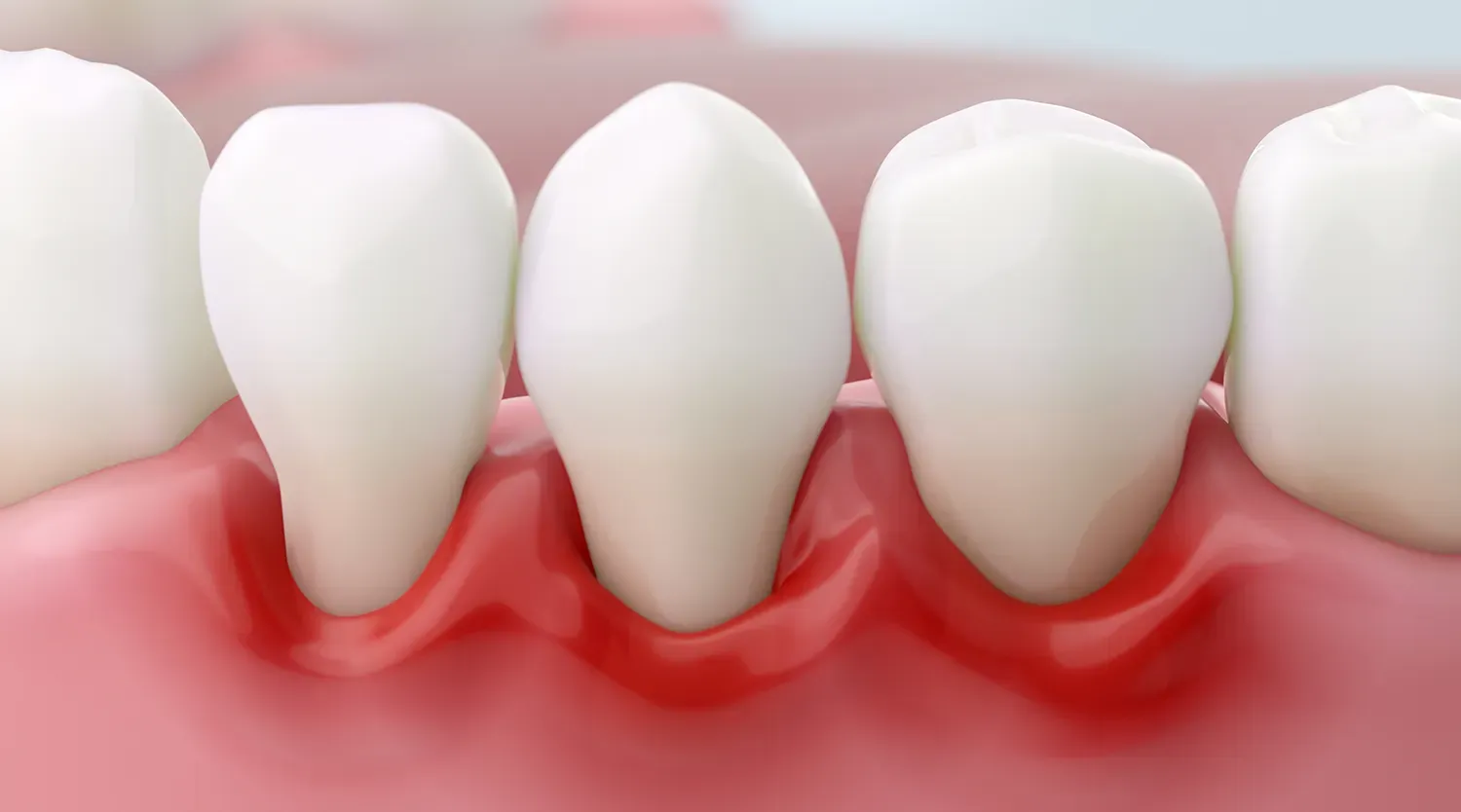 Gerötetes und geschwollenes Zahnfleisch mit typischen Anzeichen einer Gingivitis.