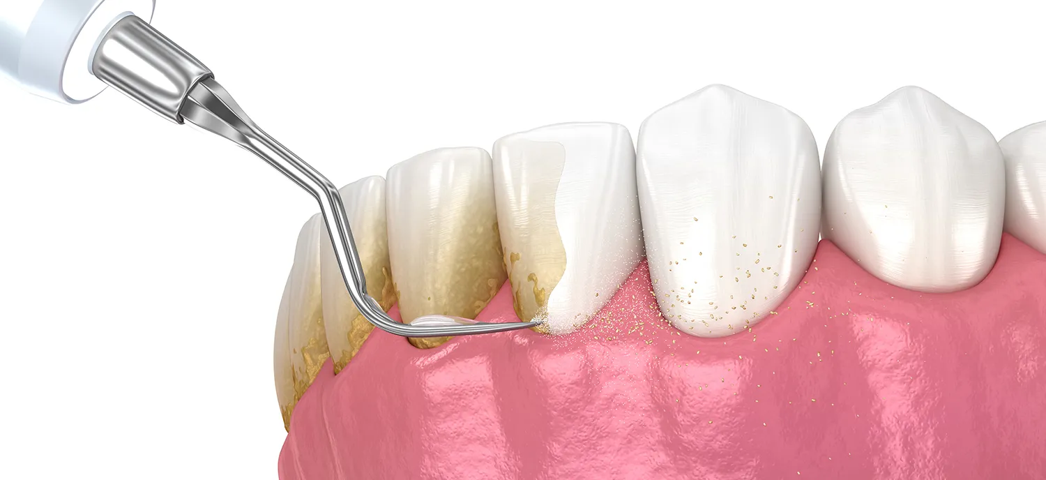 Gentle periodontal treatment at the dental practice in Zurich, Gartenstrasse