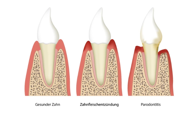 Anatomie des Zahnhalteapparates mit Zahnfleisch, Knochen und Haltefasern